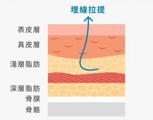 埋線 (神力拉提/藍鑽魚骨)
